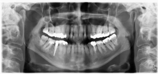x-ray mit geringer Strahlen-Belastung